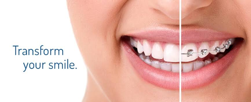 Dental Braces