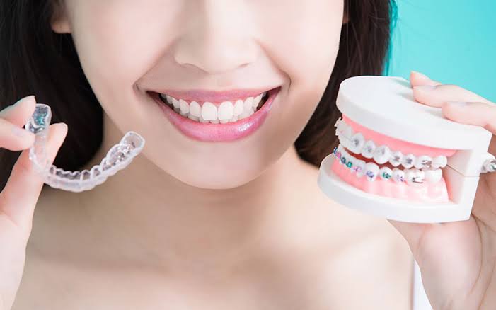 Dental Braces