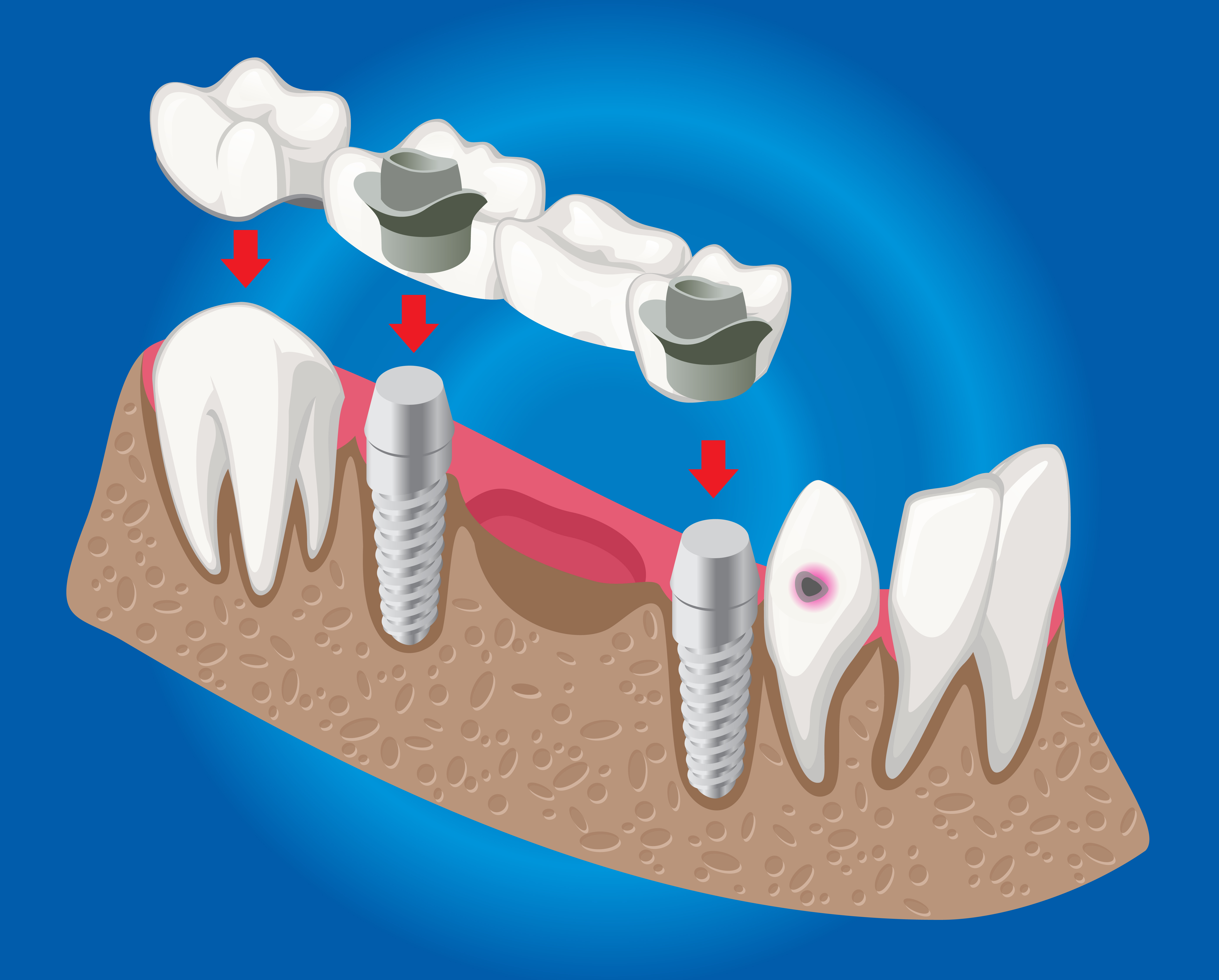 Dental Implant