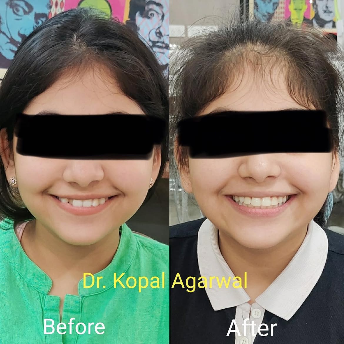 post Braces treatment