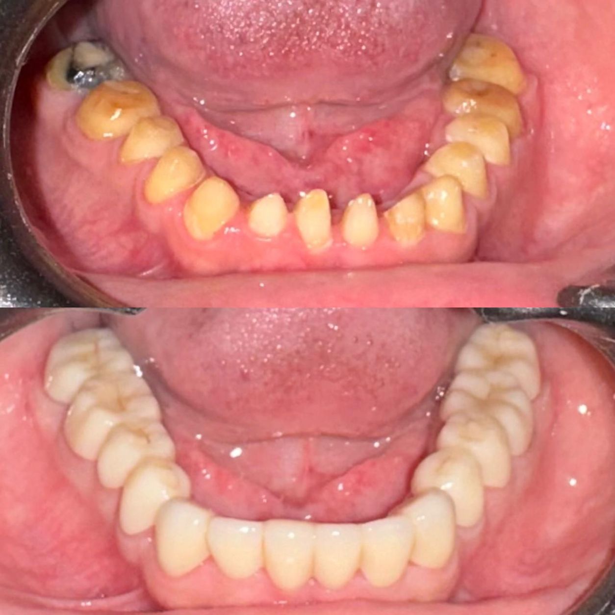 Dental Implants