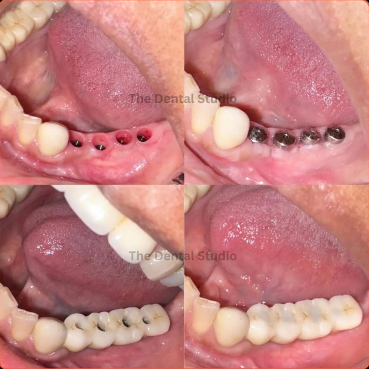 Dental Implants