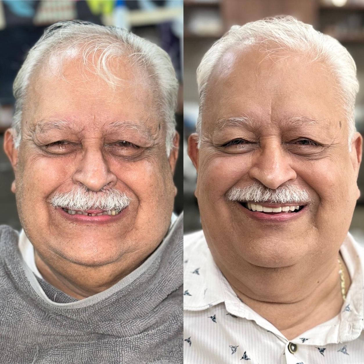 Full Smile Makeover & Restoration