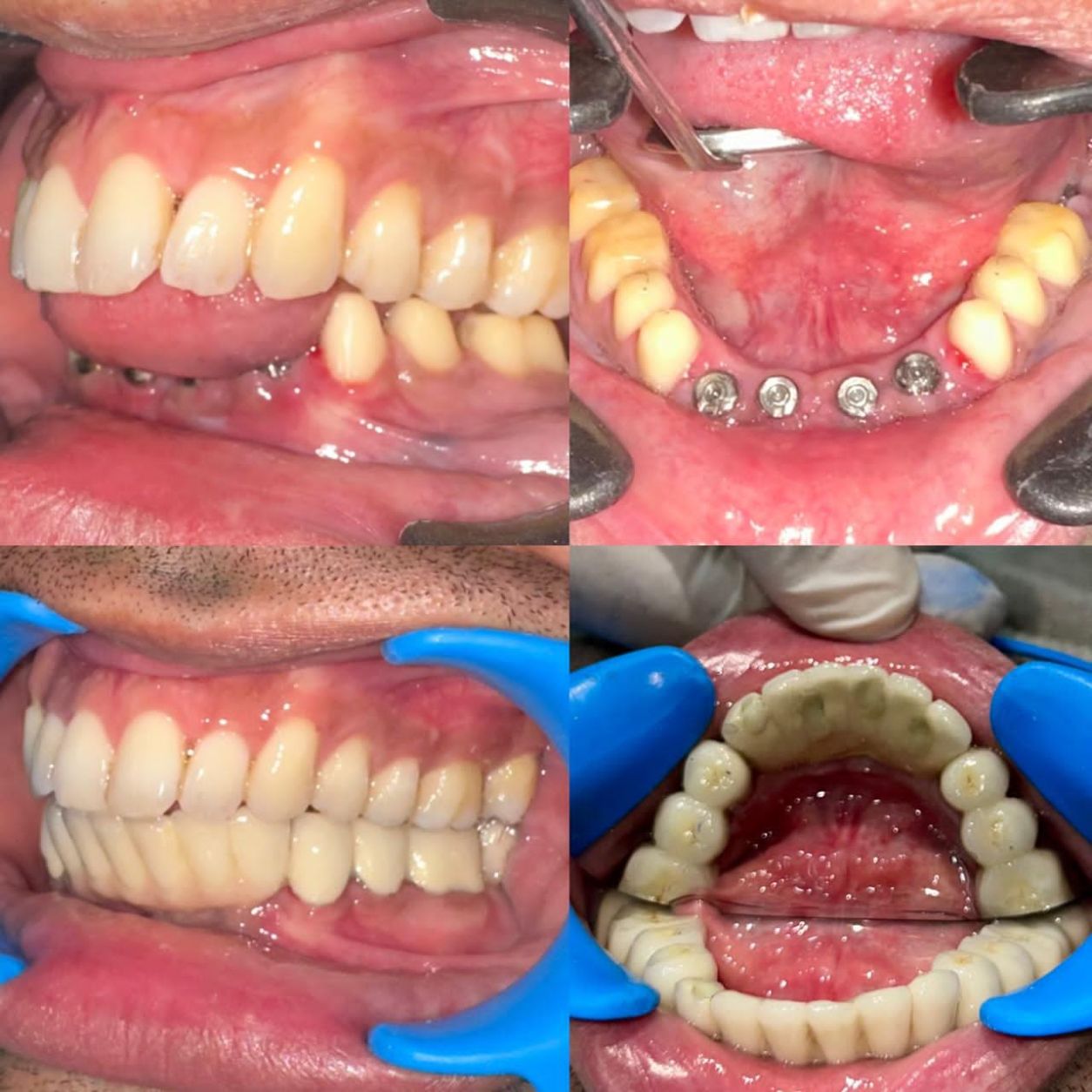 Dental Implants