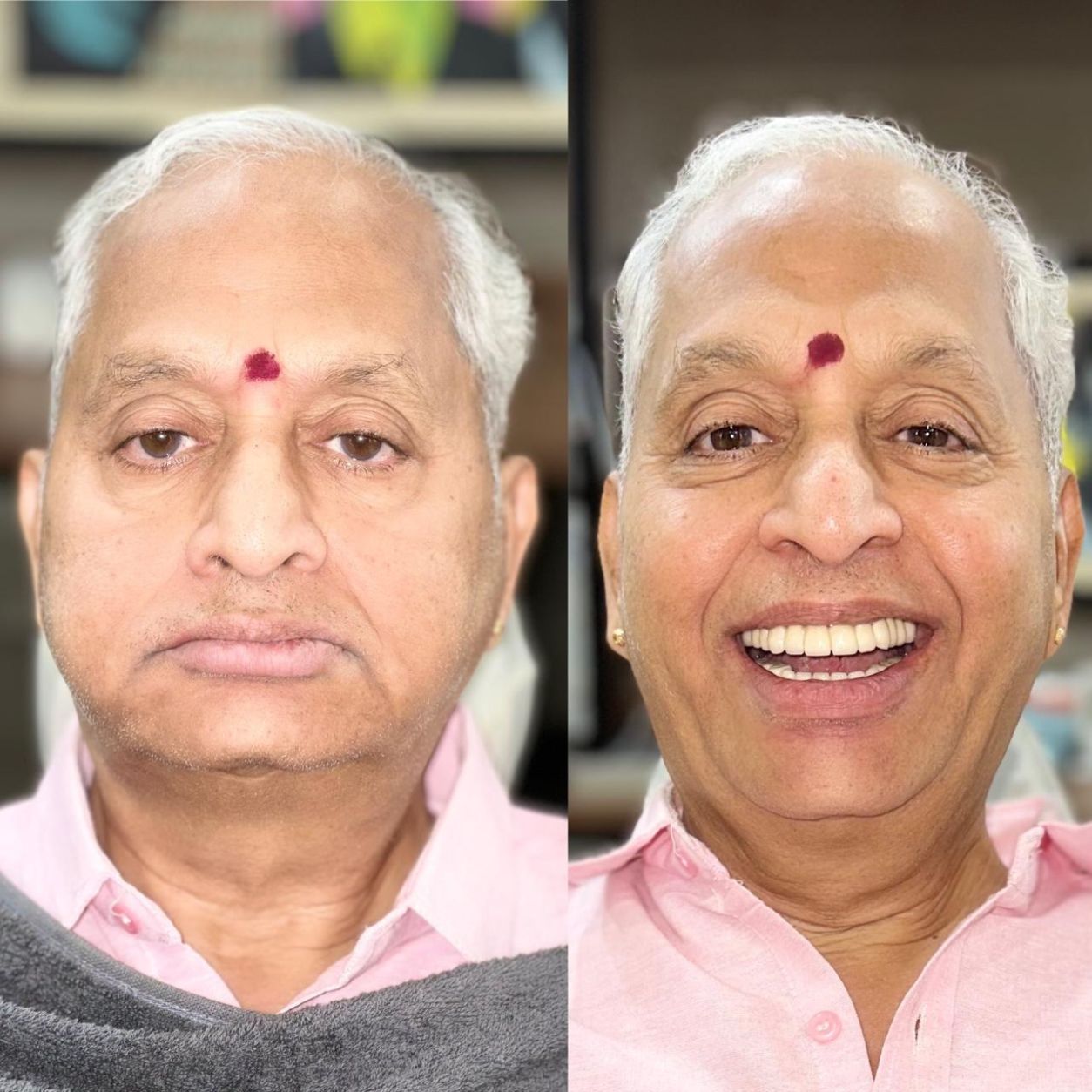 Full Smile Makeover & Restoration