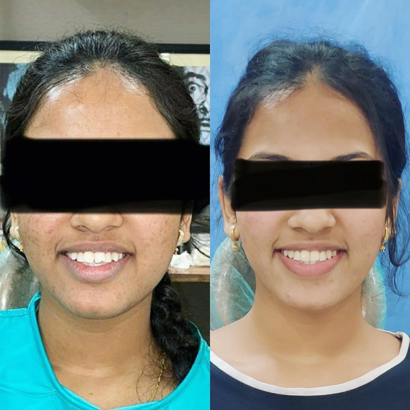 post Braces treatment