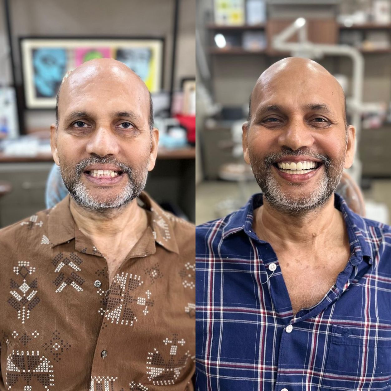 Full Smile Makeover & Restoration