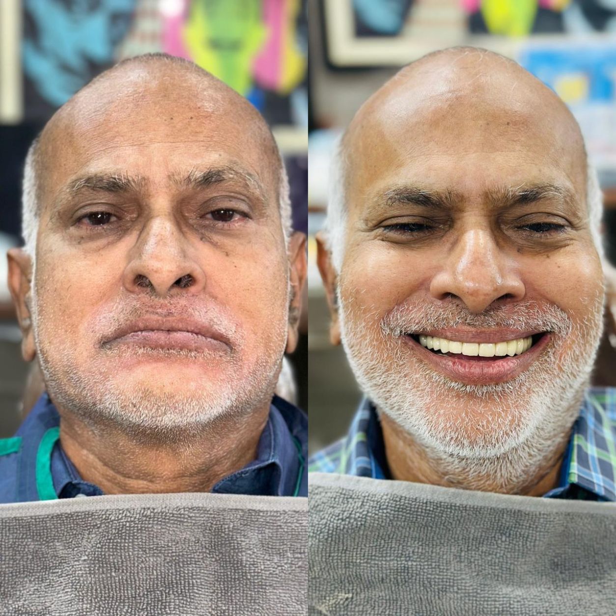 Full Smile Makeover & Restoration