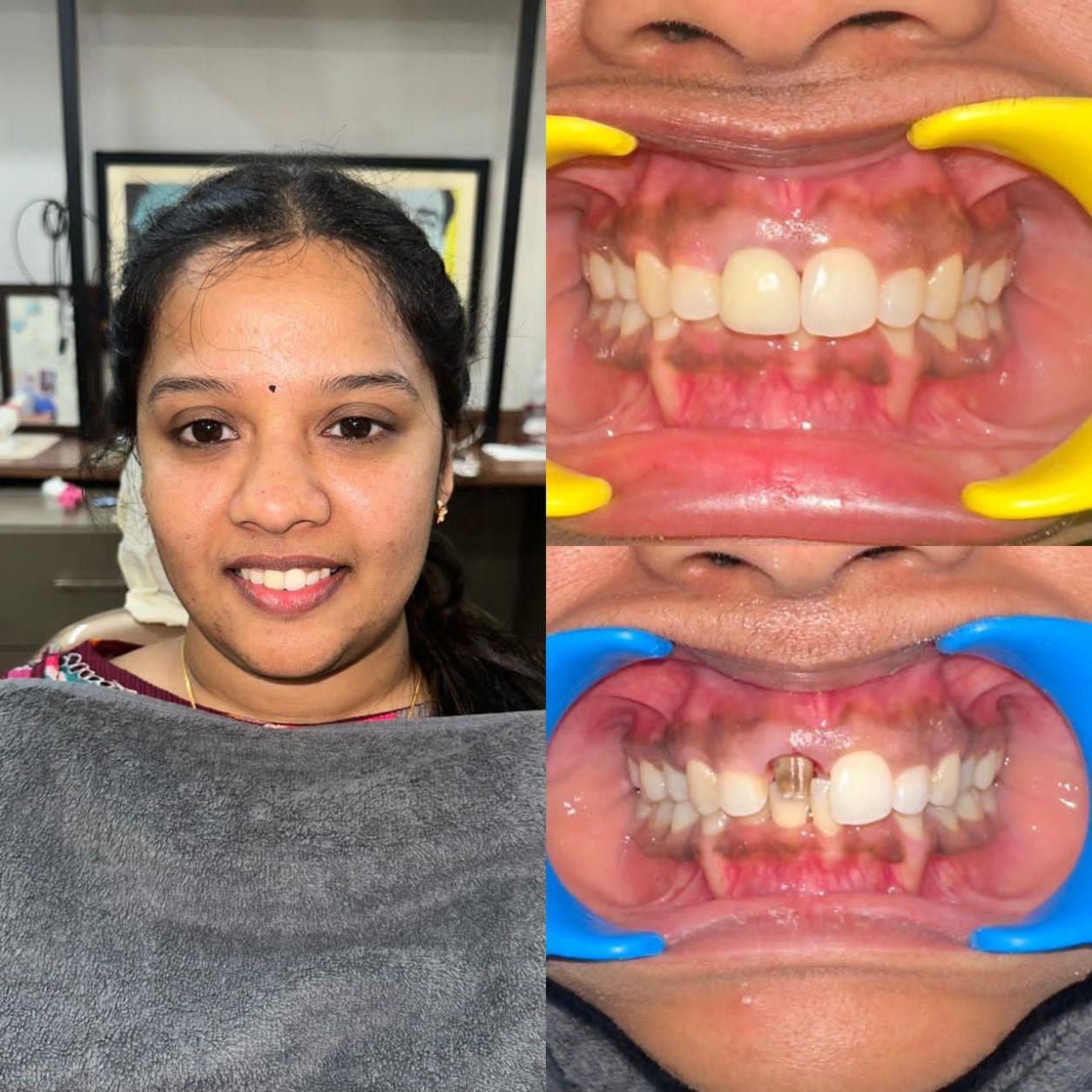 Dental Implants