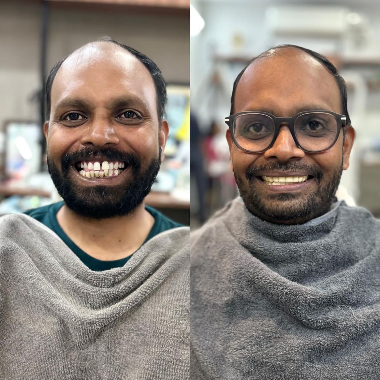 Full Smile Makeover & Restoration